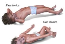 CONVULSIONAR una vez ¿es sinónimo de EPILEPSIA? Fase de las Convulsiones